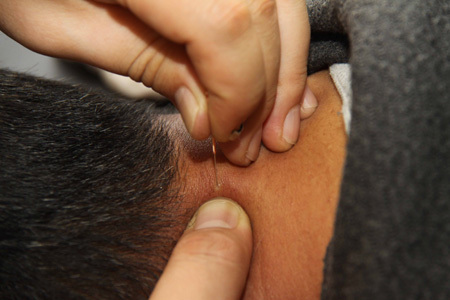 中醫針灸列入非物質文化遺產代表作名錄