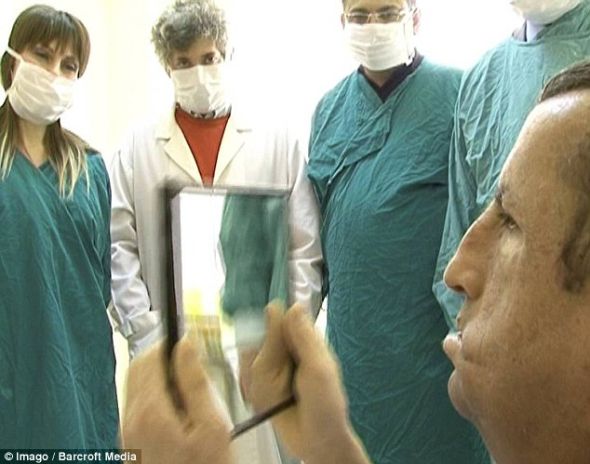 土耳其換臉人手術(shù)后首次長(zhǎng)出胡子