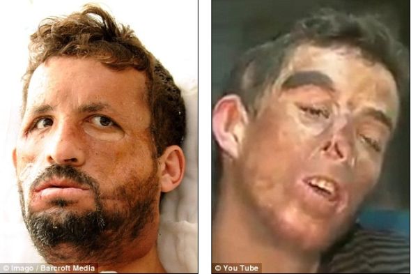 土耳其換臉人手術(shù)后首次長(zhǎng)出胡子