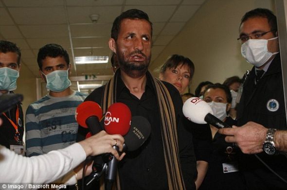 土耳其換臉人手術后首次長出胡子