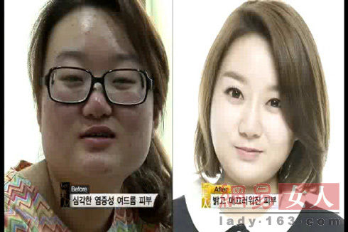 丑女變靚妹！韓國整容節目爆紅