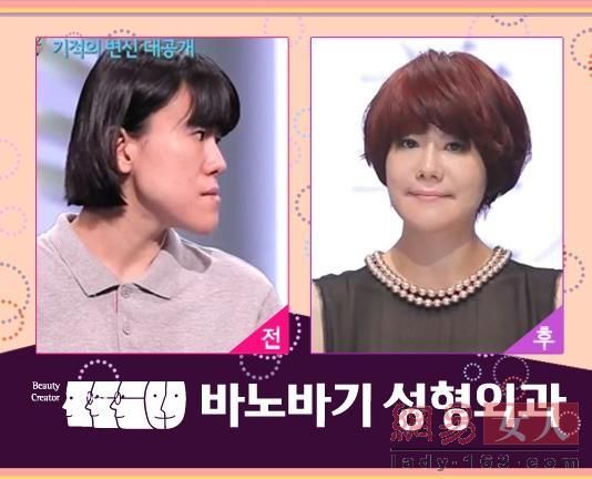 丑女變靚妹！韓國整容節目爆紅