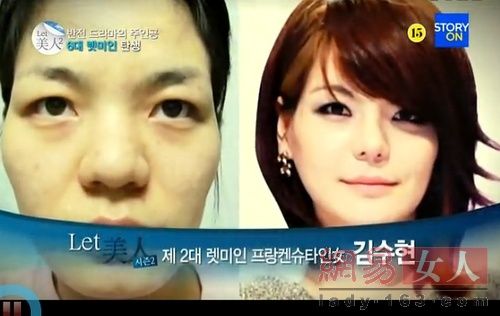 丑女變靚妹！韓國整容節目爆紅