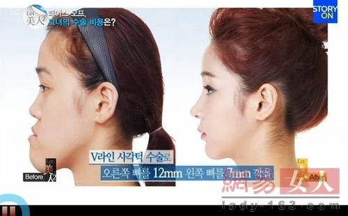丑女變靚妹！韓國整容節目爆紅