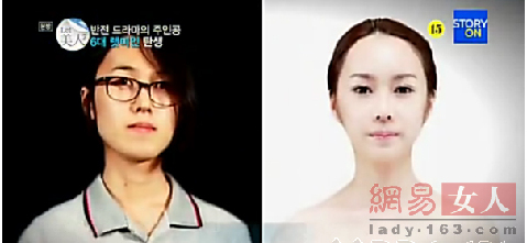 丑女變靚妹！韓國整容節目爆紅