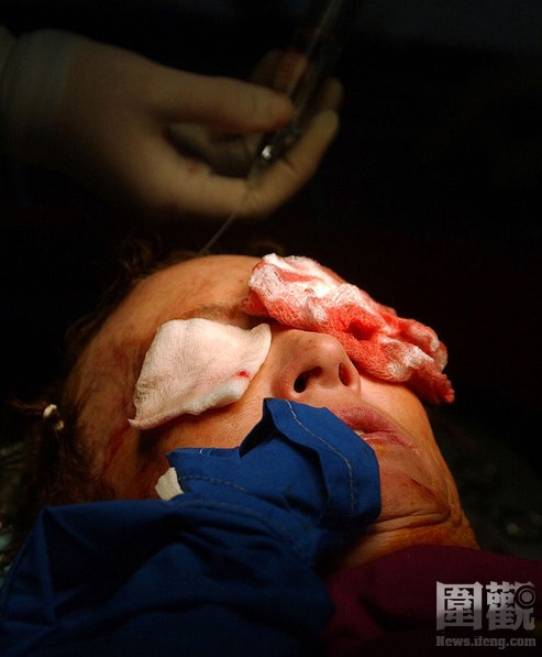 探秘國外令人觸目驚心的廉價整容