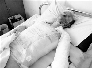 女孩拒絕前男友求婚被潑硫酸 面部無完整地方