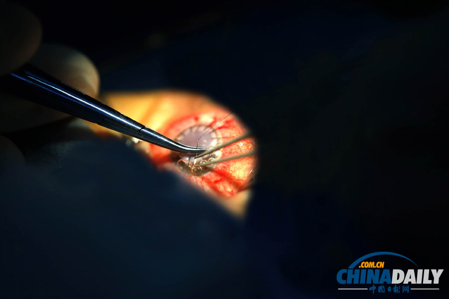 失明患者獲異國角膜“點(diǎn)亮”右眼 捐贈者車禍過世