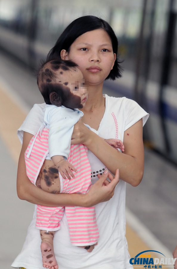 “斑點寶寶”赴上海求醫