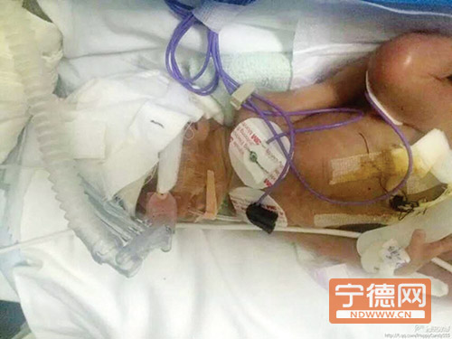 福鼎產(chǎn)婦26周早產(chǎn)雙胞胎女?huà)?兩女?huà)肟傮w重不足3斤