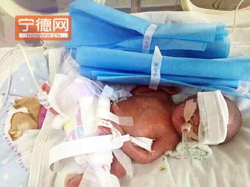 福鼎產(chǎn)婦26周早產(chǎn)雙胞胎女?huà)?兩女?huà)肟傮w重不足3斤