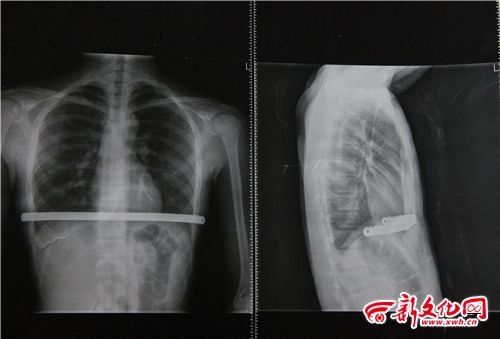 長春一初中生常莫名發燒40多度 病因仨月沒找到