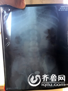聊城：幼兒園四歲女童吞下硬幣 學生家長遭遇圍毆