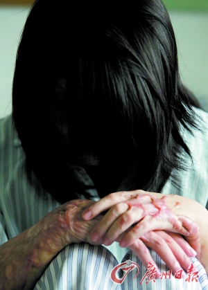 21歲女孩被前男友潑硫酸 選擇堅(jiān)強(qiáng)重新來過(圖)