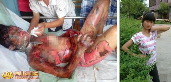 四川:17歲少女被開水燙傷如被剝皮 雙手面臨截肢