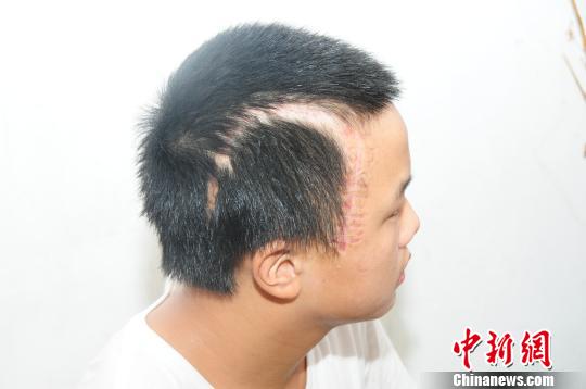 14歲男孩車禍重傷 因無力支付高額手術費父拒認子