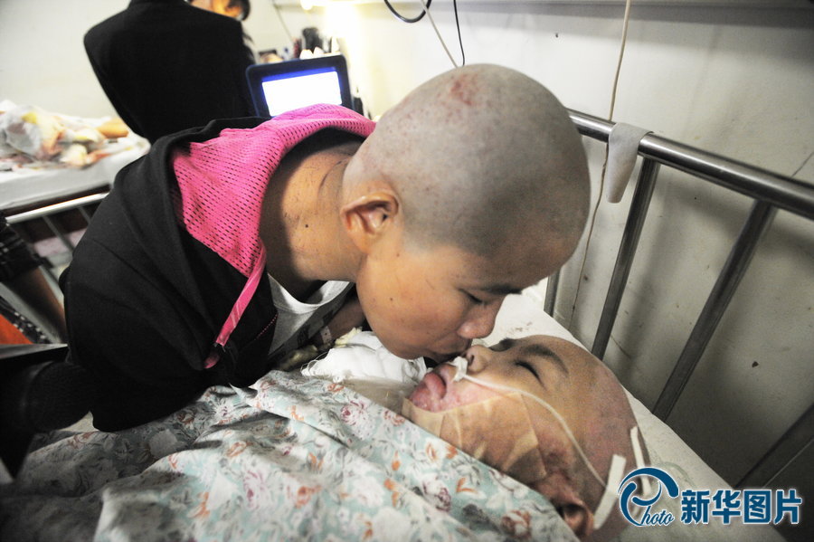 7歲女童全身70%面積燒傷 養(yǎng)母捐整塊頭皮救女