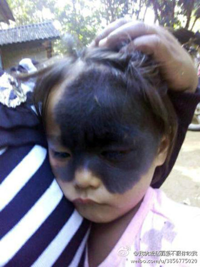 云南孟連“面具女孩”黑斑遮住半張臉 網(wǎng)上求助（圖）