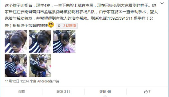 云南孟連“面具女孩”黑斑遮住半張臉 網(wǎng)上求助（圖）