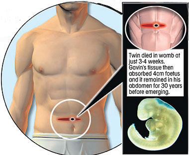 如電影《異形》再現 英男子腹部驚迸寄生胎
