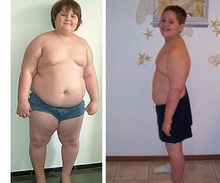 減肥手術最小患者：美國10歲男孩“切胃”救命