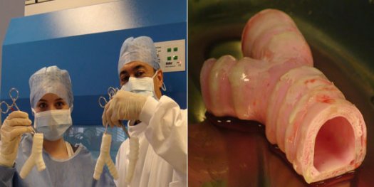 醫(yī)學界新突破:瑞典完成世界首例人造器官移植