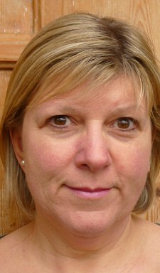 日光浴曬出癌癥 英國婦女右耳被切戴假耳朵度日