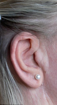 日光浴曬出癌癥 英國婦女右耳被切戴假耳朵度日