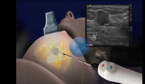 不開刀無疤痕 以色列科學家開發乳腺癌“冰球”療法